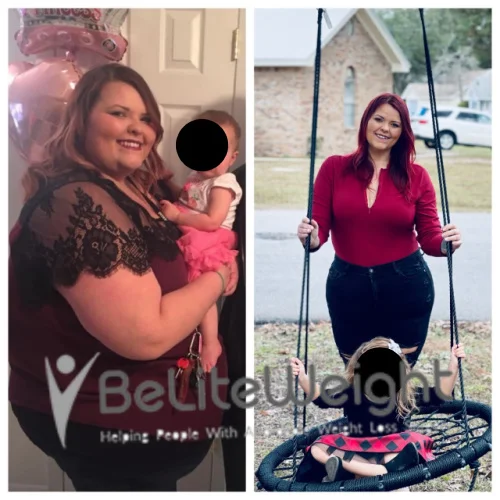 Weight Loss Surgery Before And After
